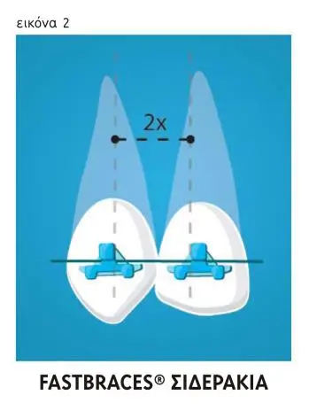 h-diafora-tou-sistimatos-fastbraces_fastbraces_siderakia