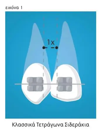 h-diafora-tou-sistimatos-fastbraces_klasika_siderakia